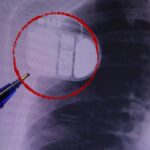 Kalp pili taşıyanlar dikkat! Soğuk Uyarısı: “Üşüme Cihazınızı Aldatabilir” Sağlık Haberleri